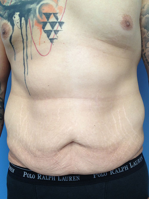 Washington Male Abdominoplasty/Body Lift Before and After Photos - DC  Plastic Surgery Photo Gallery - Dr. Michael Olding406 - Olding, Michael  ()