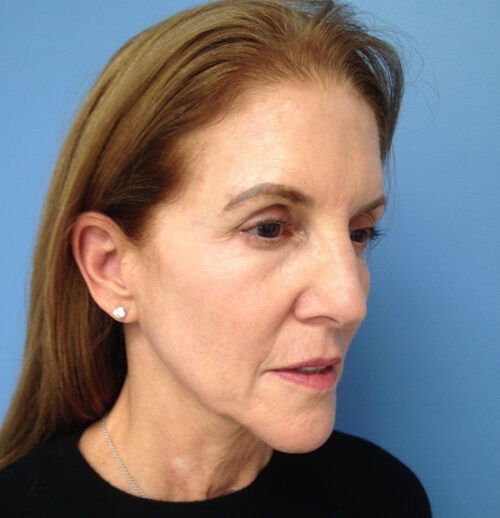 Face & Neck Lift