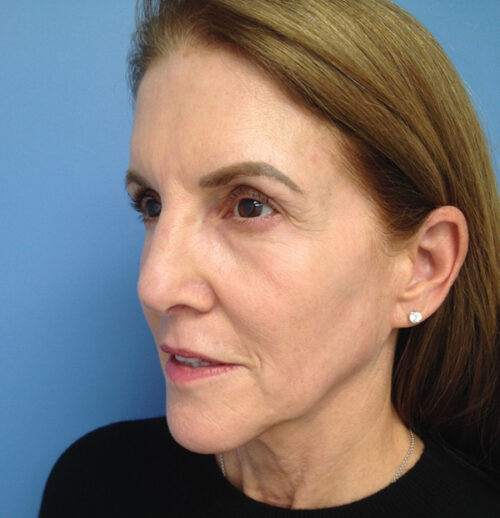 Face & Neck Lift