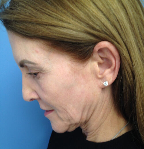 Face & Neck Lift