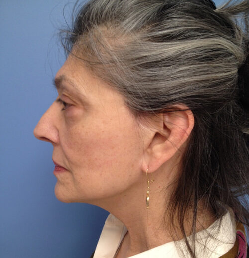 Face & Neck Lift